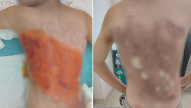 12 yaşındaki çocuğa akran zorbalığı dehşeti. Sırtını kolonya ile yaktılar!