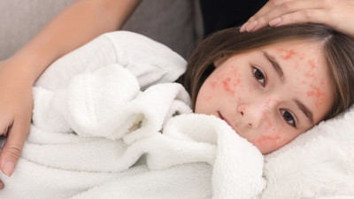 Kızamık vakaları hızla artıyor, DSÖ'den uyarı geldi