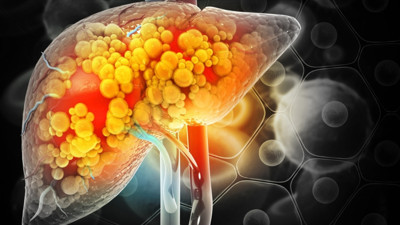 Karaciğer yağlanmasının genetik nedeni bulundu