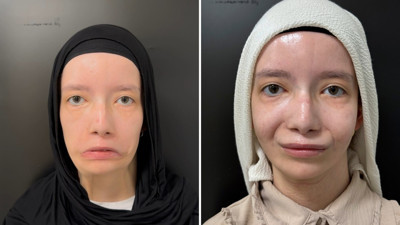 Mimiksiz doğmuştu: 23 yıl sonra gelen gülümseme