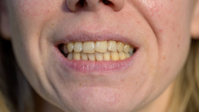 Uzmanlar anlattı: Diş renginiz hangi hastalığın habercisi?