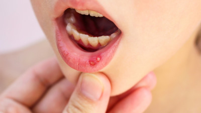 Uzmanı anlattı: Dudaklarınız sağlığınızla ilgili ne anlatıyor?