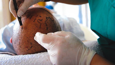 Resmi Gazete'de yayınlandı: Saç ekiminde yeni dönem