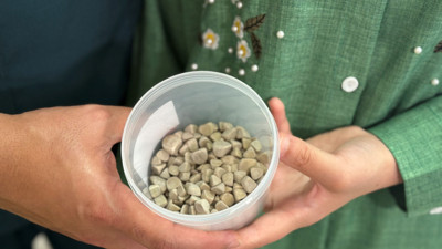 Bir ameliyatta 287 taş çıkarıldı