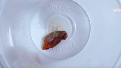 Bir buçuk yıldır geçmeyen öksürüğün sebebi hayrete düşürdü