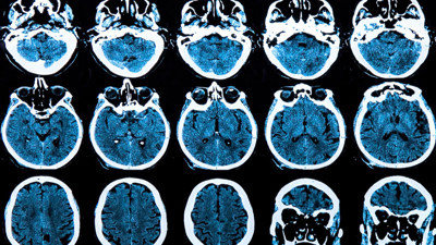Huntington hastalığını yavaşlatmayı başardılar