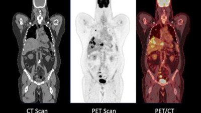Zayıflama ilaçlarının endişe yaratan yeni yan etkisi tespit edildi