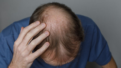 Kelliğe karşı umut veren araştırma