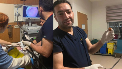 Yemek borusuna kaçan ceviz endoskopik operasyonla çıkarıldı