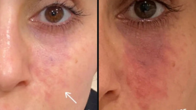 Estetik dolguda kritik uyarı: Körlük tehlikesi ortaya çıktı