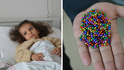 Karın ağrısıyla hastaneye götürülen 4 yaşındaki Eda’nın bağırsağından 8 mıknatıs çıktı