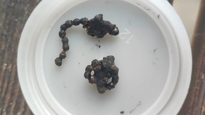 5 yaşındaki çocuğun burnundan çıkan şey hayrete düşürdü