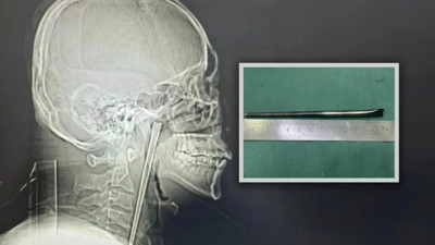 Sekiz yıl boğazında metal çubukla yaşadı