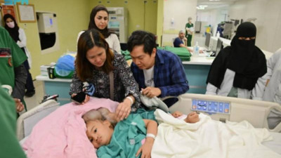 Yapışık ikizleri ayırmak 18,5 saat sürdü