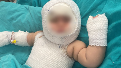 9 aylıkken üzerine domates konservesi patladı: Aylar sonra iyileşti