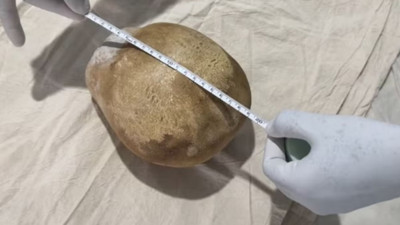 Hastanın vücudundan çıkarılan 3 kiloluk taş şaşkınlık yarattı