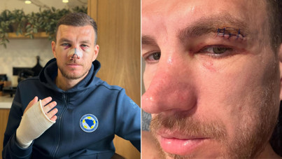 Burnu kırılan Dzeko son halini paylaştı