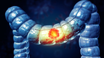 Sağlıklı beslenmek yetmiyor... Kanseri önleyen üç kritik adım