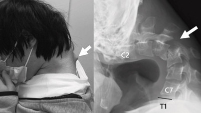 Sürekli telefonuna bakan 25 yaşındaki gencin boynu yamuldu