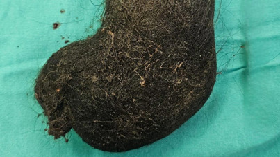 Aileler dikkat: 9 yaşındaki çocuğun midesinden çıktı