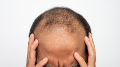 Bilim insanları: Kelliğe çözüme bir adım kaldı