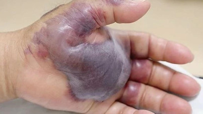 Sağlık Bakanlığı'ndan 'vibrio bakterisi' açıklaması