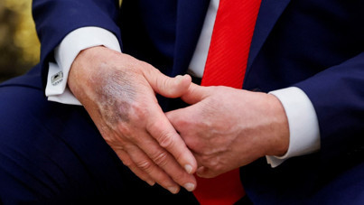 Beyaz Saray'dan Trump'ın eliyle ilgili açıklama geldi