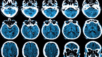 Huntington hastalığını yavaşlatmayı başardılar