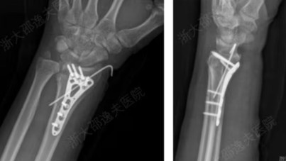 Çığır açacak buluş: Kırıkları dakikalar içinde onarabiliyor