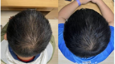 Kelliğe umut: 2 ayda saç çıkaran formül yaptılar