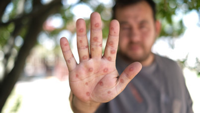 DSÖ: Avrupa'da maymun çiçeği virüsü görüldü