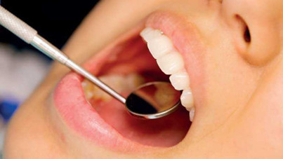 İnsan vücudunda da var: Diş çürümesine karşı dikkat çeken keşif