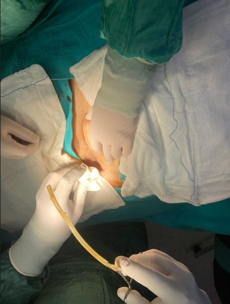 Karnında hortum unuttular: Bakanlıktan özür dileriz, olur biter - Resim : 1