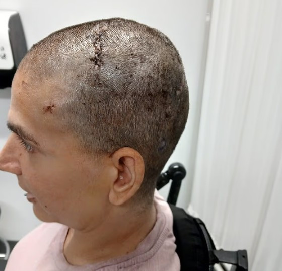 20 yıldır felçli kadın, beyin çipinin şoke edici etkisini gösterdi - Resim : 1