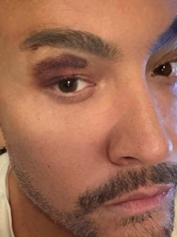 Cenk Eren sahnede talihsiz an yaşadı: Son halini paylaştı - Resim : 1