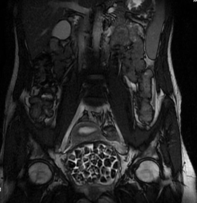 Bir ameliyatta 287 taş çıkarıldı - Resim : 2