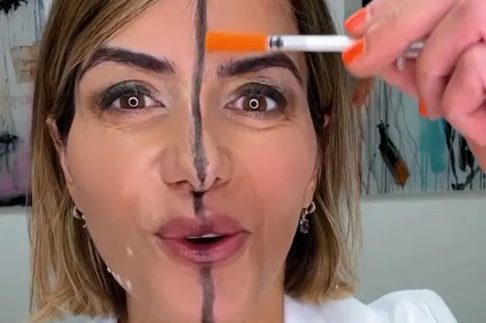 Yüzünün sadece bir tarafına botoks uyguladı, aradaki beklenmedik farkı gösterdi - Resim : 1