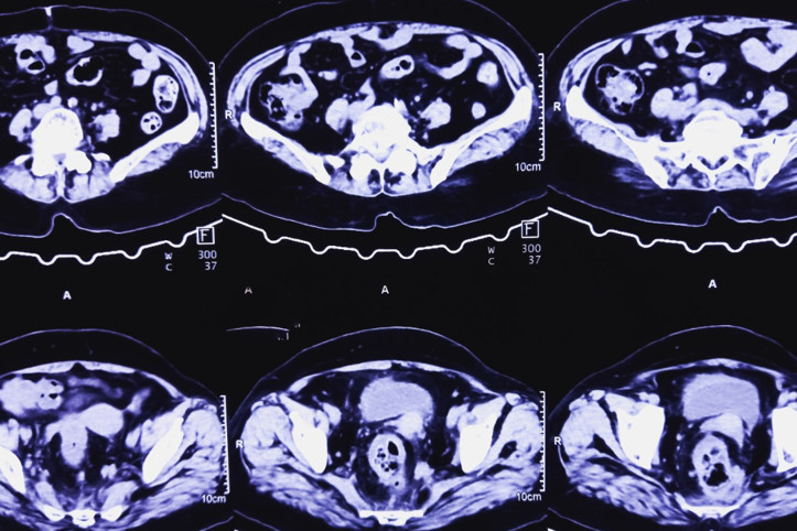 Korkutan kolon kanseri araştırması: Maalesef Türkiye en üstlerde