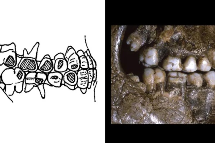 29 bin yıllık diş kanıtı: Buz Devri insanları yanak piercingi kullanıyormuş