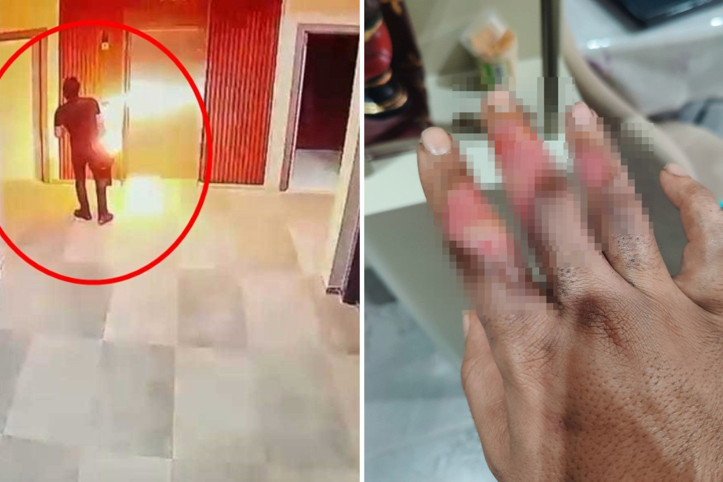 Elektrikli skuterin bataryası elinde patladı