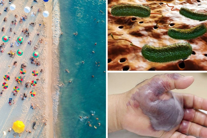 Plajlarda 'et yiyen bakteri' paniği: Enfekte her 5 kişiden 1'i...