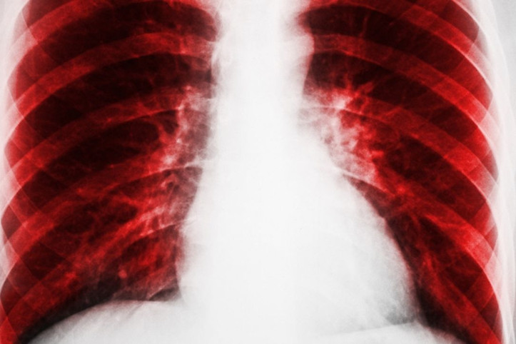 Akciğer hastalarının dikkatine: Bu üç şarkıyı söylemek iyi geliyor