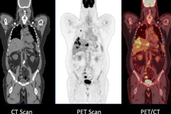 Zayıflama ilaçlarının endişe yaratan yeni yan etkisi tespit edildi