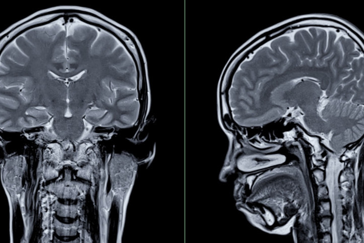 Araştırma: Erkek beyni, kadınlarınkinden daha hızlı küçülüyor