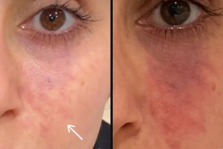 Estetik dolguda kritik uyarı: Körlük tehlikesi ortaya çıktı