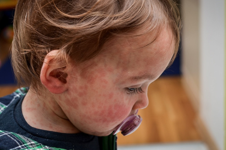 Başkentte kızamık paniği: 60 öğrenci hastalandı