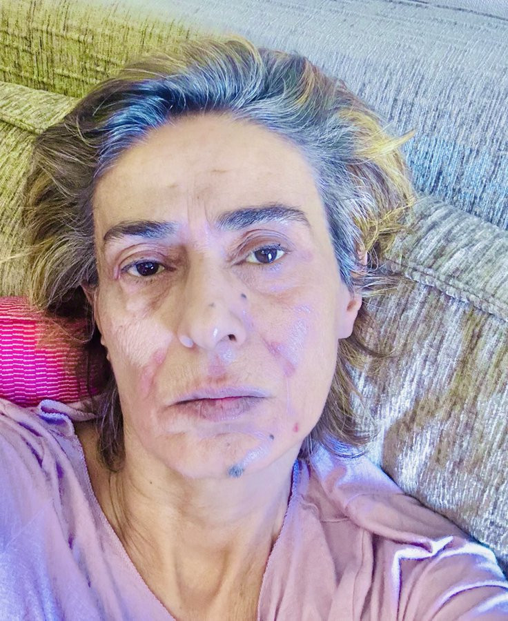 Yıldız Tilbe’nin son hali endişelendirdi! Yüzündeki yara izleri dikkat çekti - Resim : 1