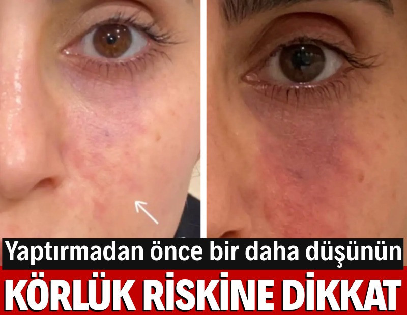 Estetik dolguda kritik uyarı: Körlük tehlikesi ortaya çıktı