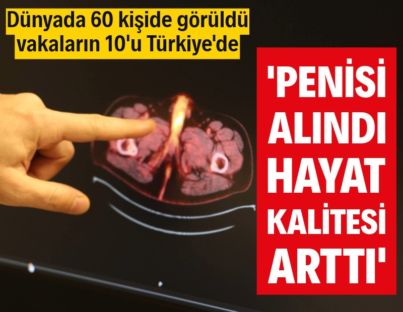 Dünyada 60 kişide görüldü, 10'u Türkiye'de: Penisi alındı, hayat kalitesi arttı