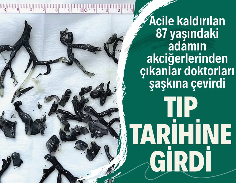 Akciğerlerinden çıkan tıp dünyasını şaşkına çevirdi